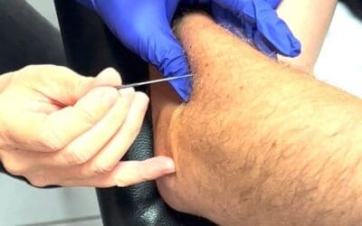 dry needling formation à bouc bel air