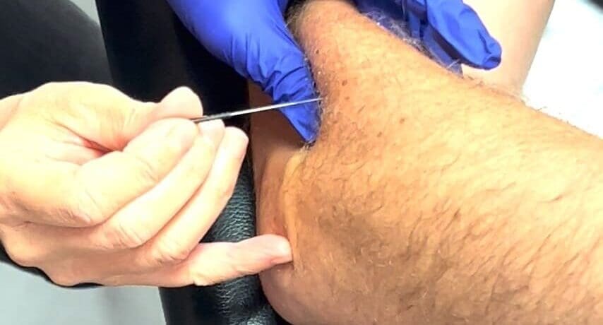 Dry Needling perfectionnement – quadrant supérieur (14-16 Juin 2025) Toulouse