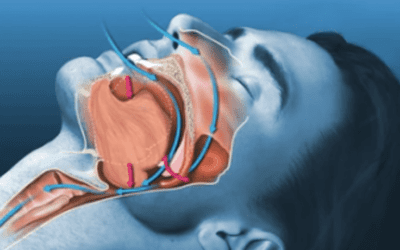 Formation Syndrome d’apnée obstructive du sommeil (SAOS) et ATM (nouvelle formation) Formation Syndrome d’apnée obstructive du sommeil (SAOS) et ATM (nouvelle formation)