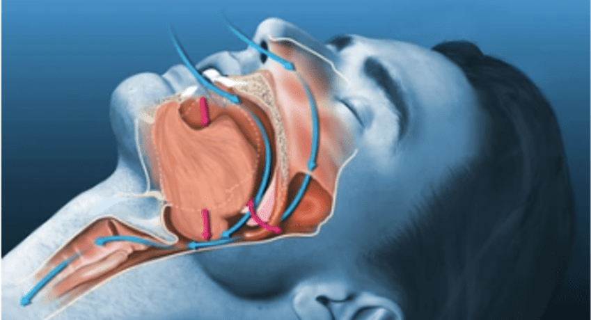 Formation Syndrome d’apnée obstructive du sommeil (SAOS) et ATM (nouvelle formation)